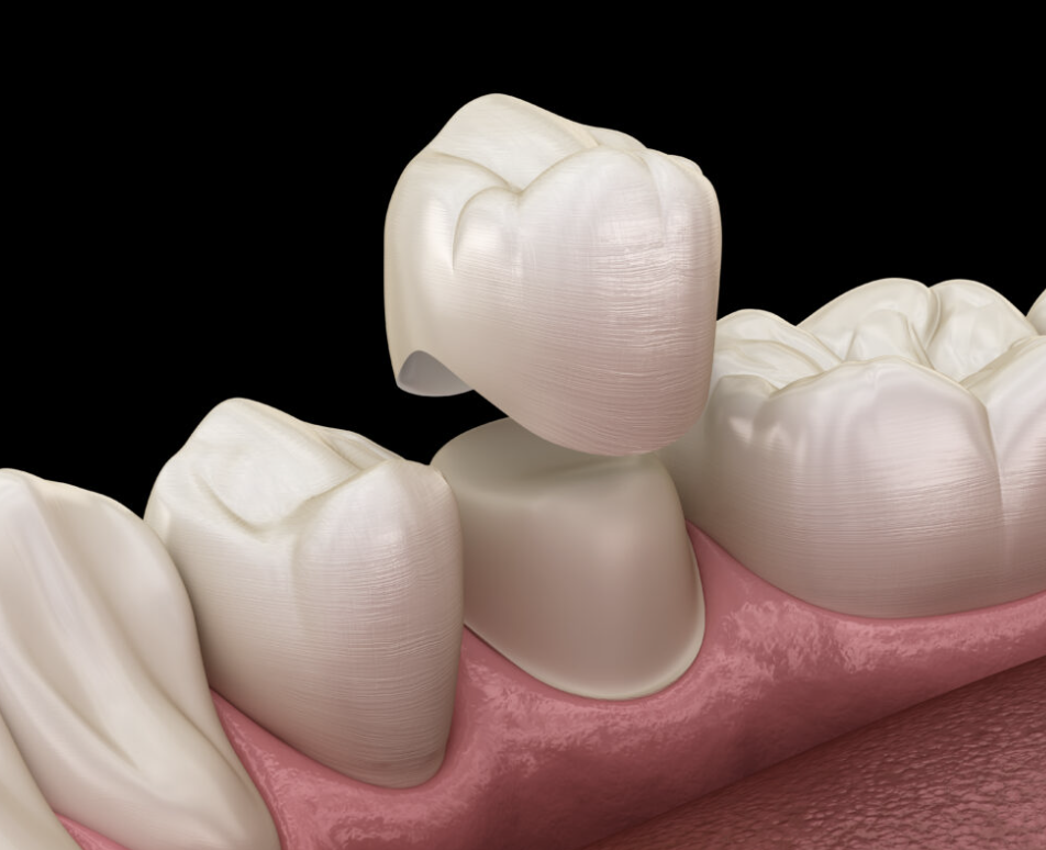 Dental crown placed on tooth in Grayson dental office